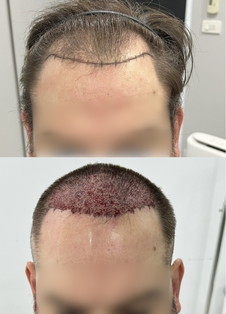 植毛 at MENHANCE — the designed hairline before, and freshly implanted grafts on the day
