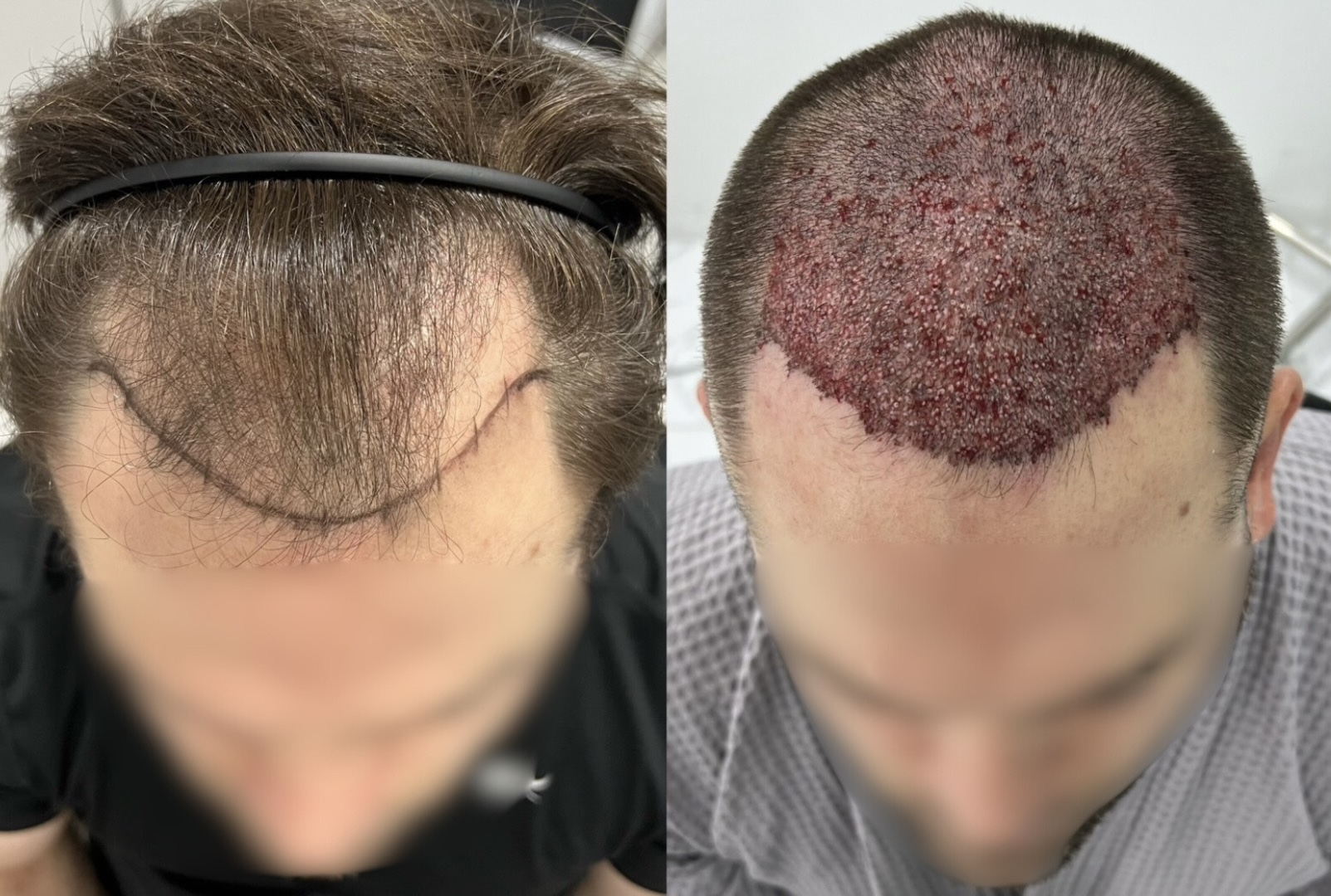 植毛 at MENHANCE — before, and implanted grafts on the day of the DHI procedure