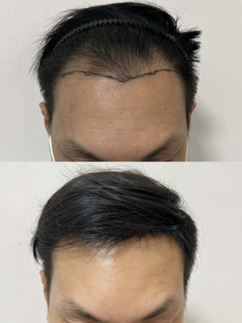 植毛 before and after at MENHANCE — a thinning hairline restored to full density