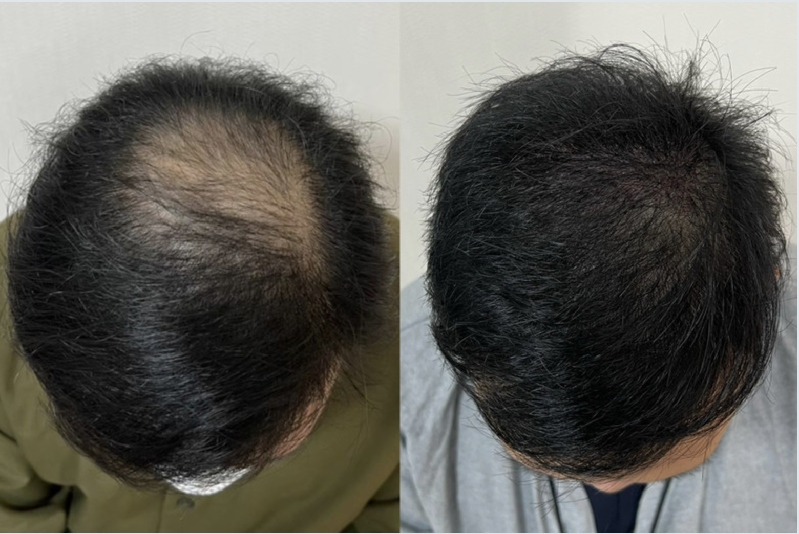 植毛 before and after at MENHANCE — a thinning crown restored to fuller density