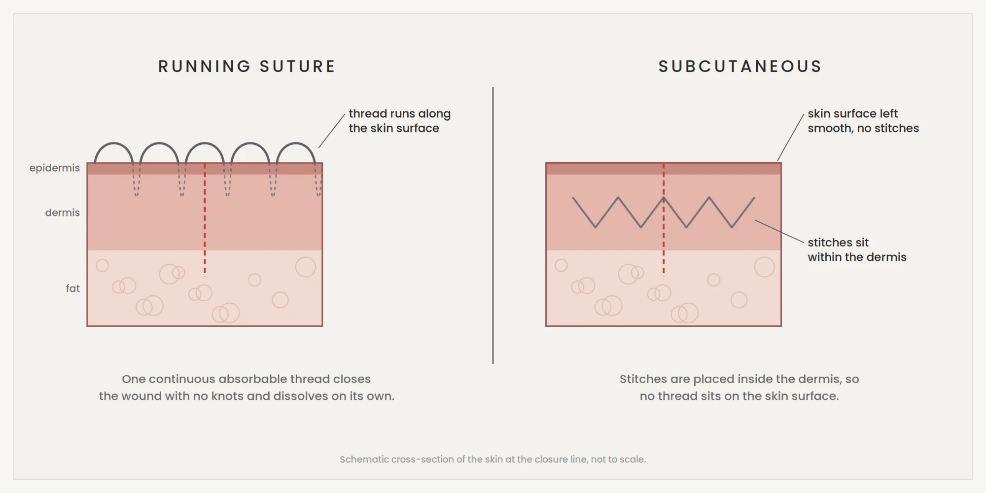 Running absorbable suture vs hidden subcutaneous stitches after circumcision