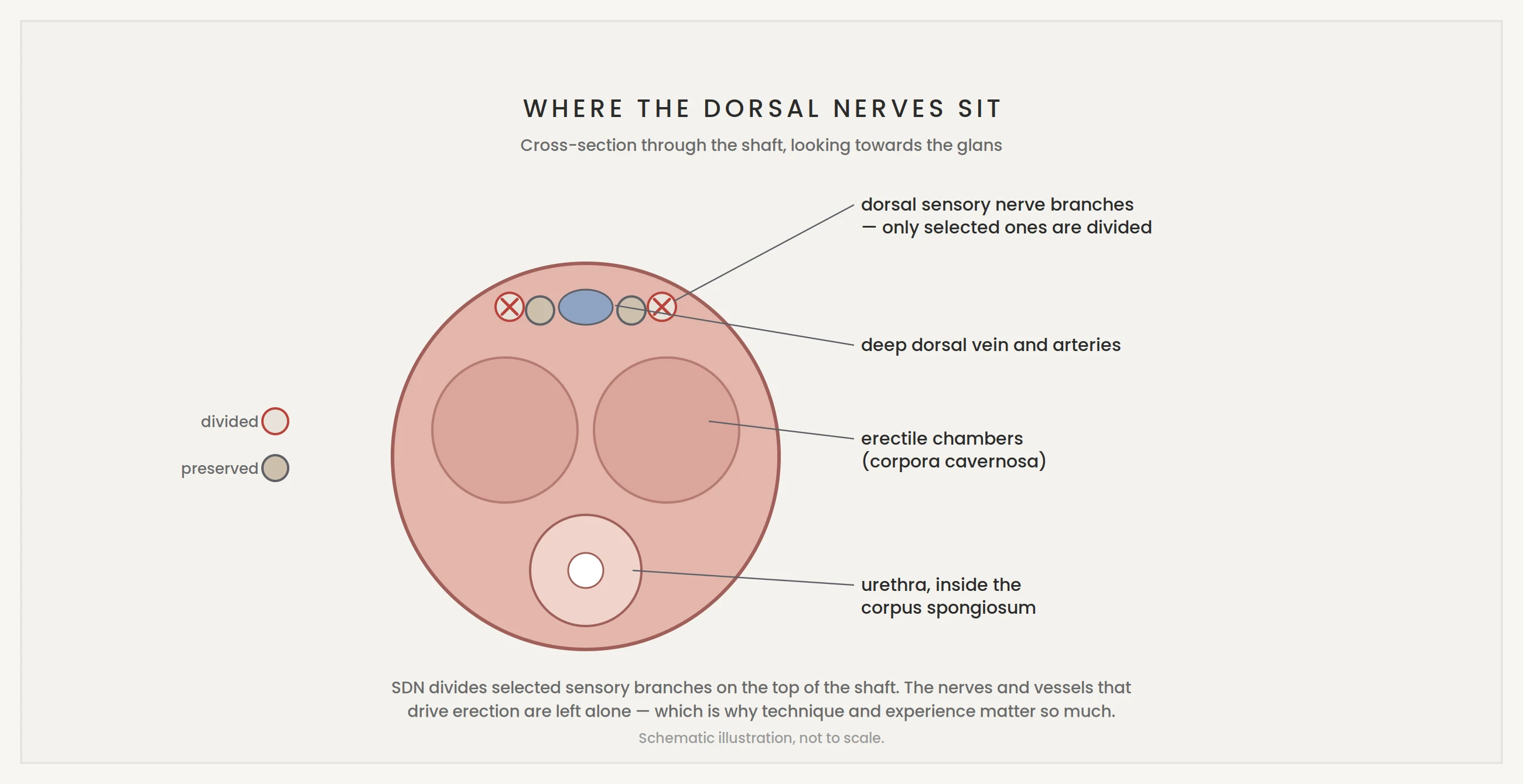 Cross-section showing dorsal penile nerves divided in selective dorsal neurectomy