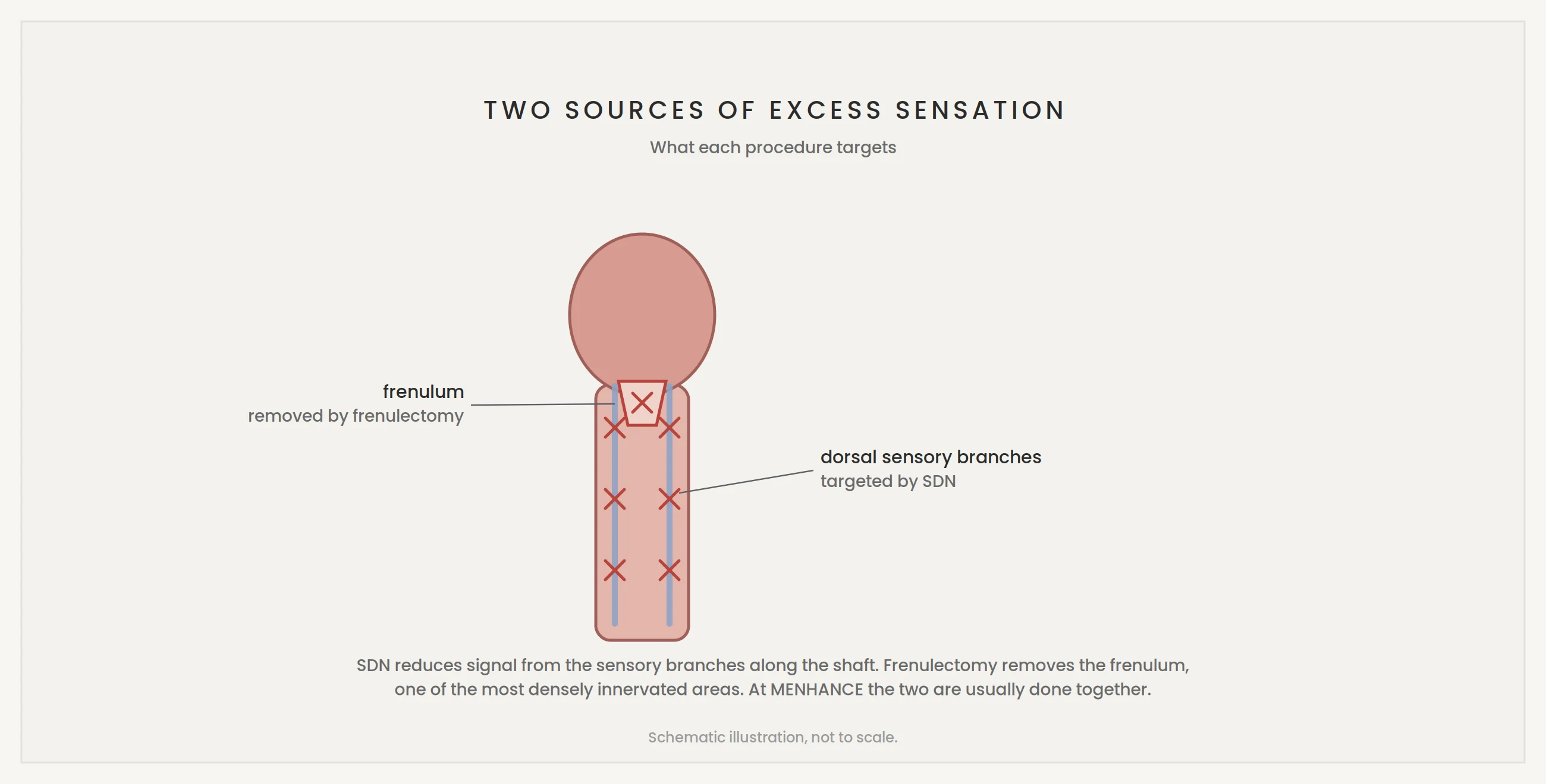 Dorsal nerves and frenulum, the two targets of SDN and frenulectomy