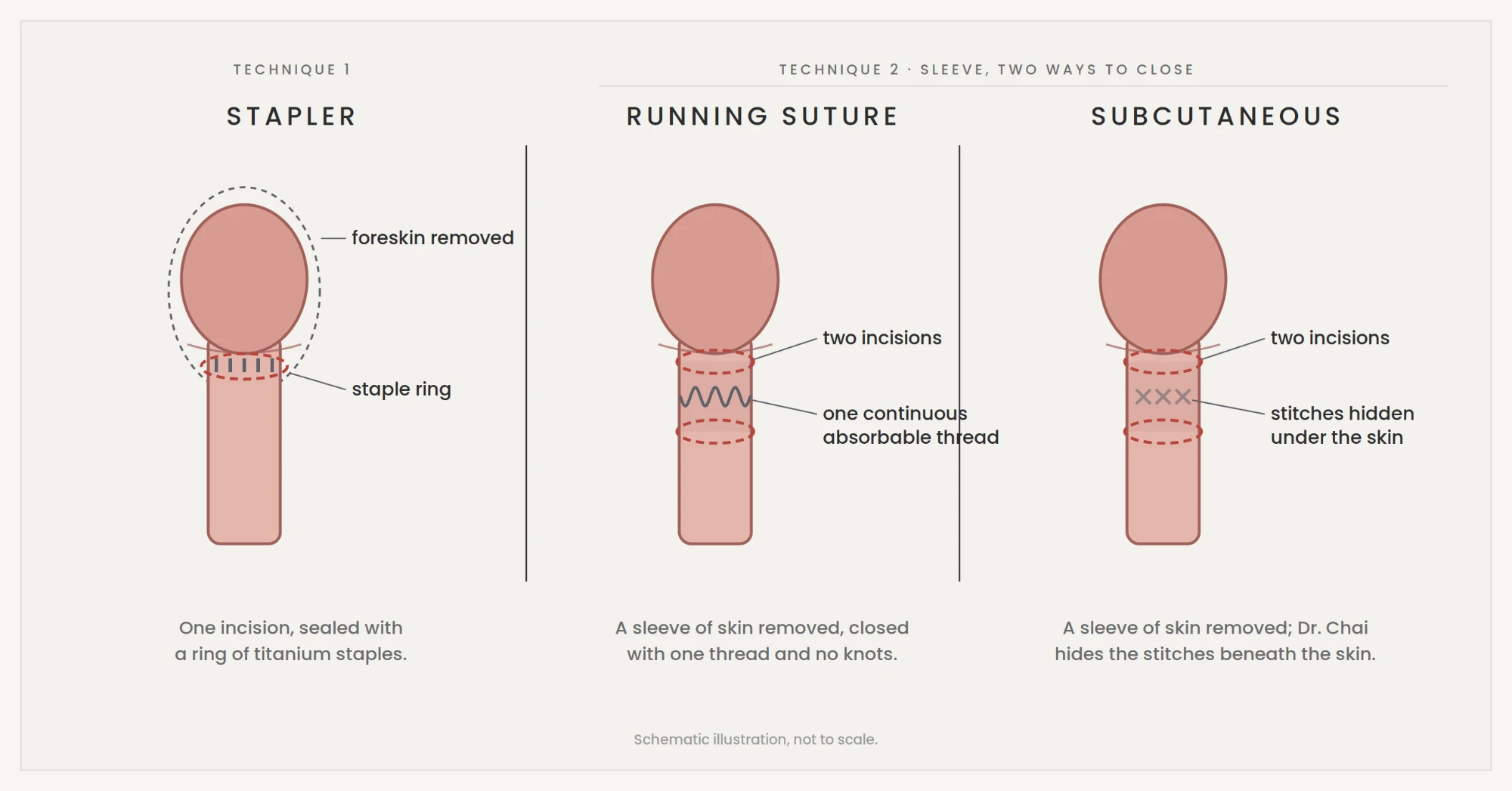 Types of circumcision compared: stapler, running suture and subcutaneous stitches