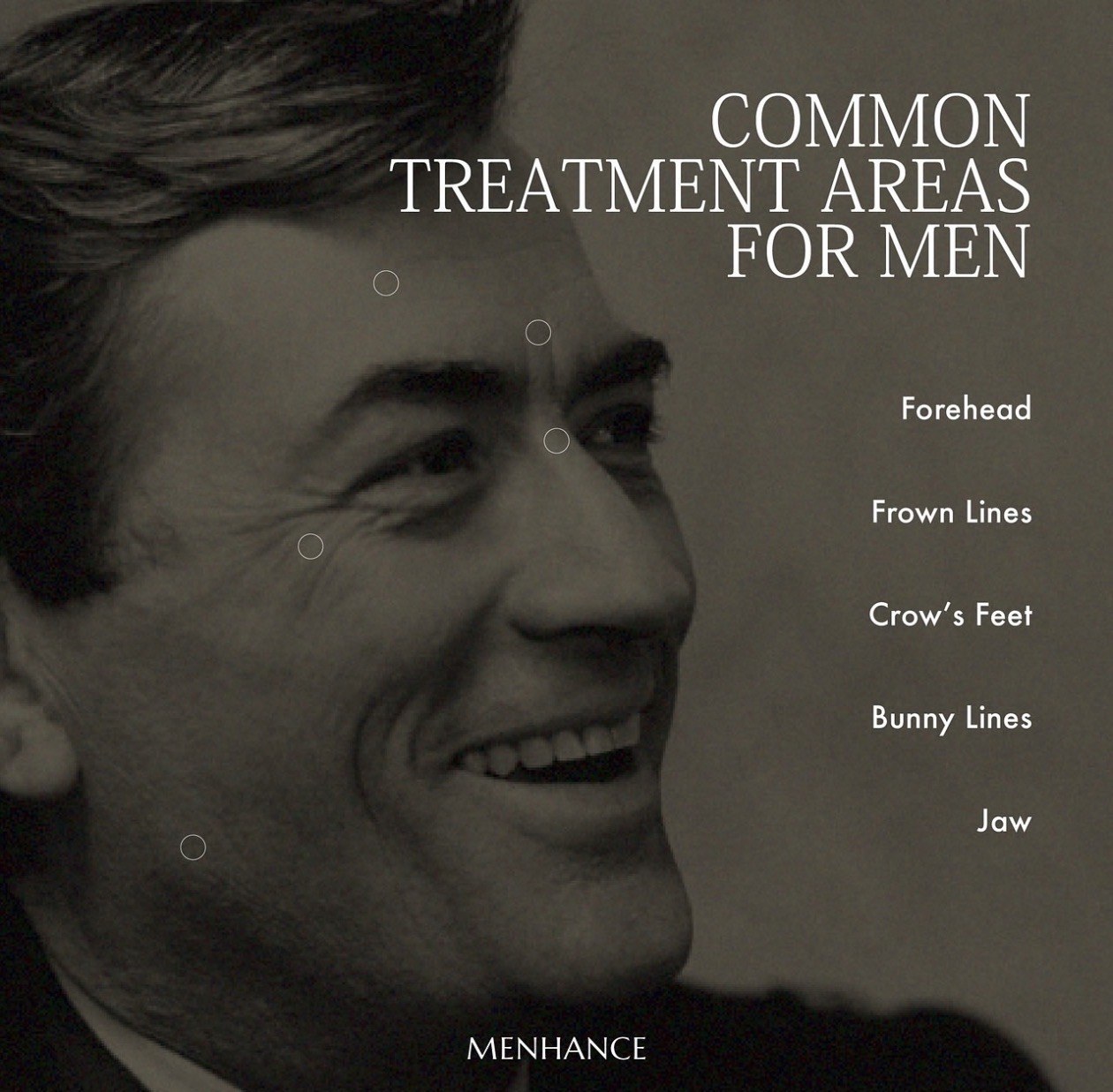 Brotox — common botulinum treatment areas for men