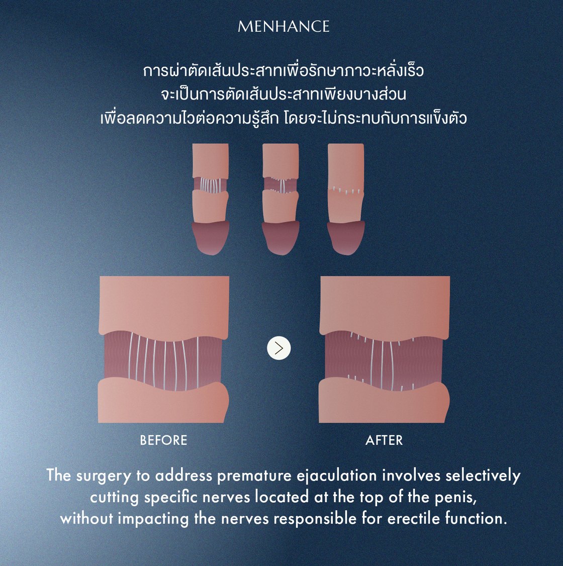 Selective Dorsal Neurectomy microsurgery at MENHANCE